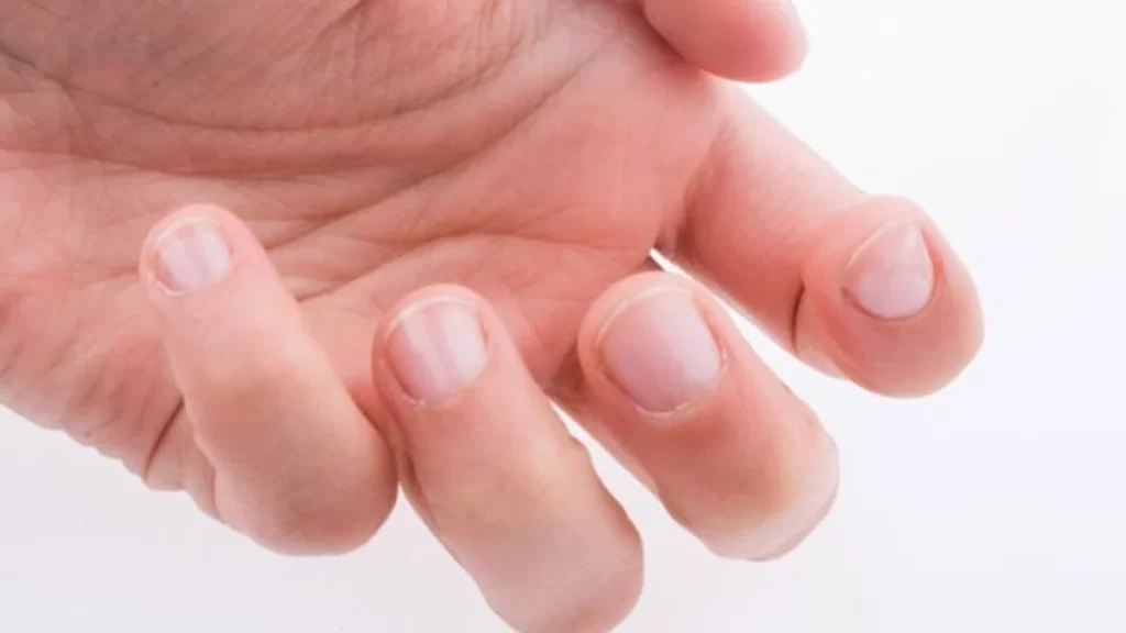 Parmak ve Tırnak Değişiklikleri, Bazı Hastalıkların Erken Belirtisi Olabilir