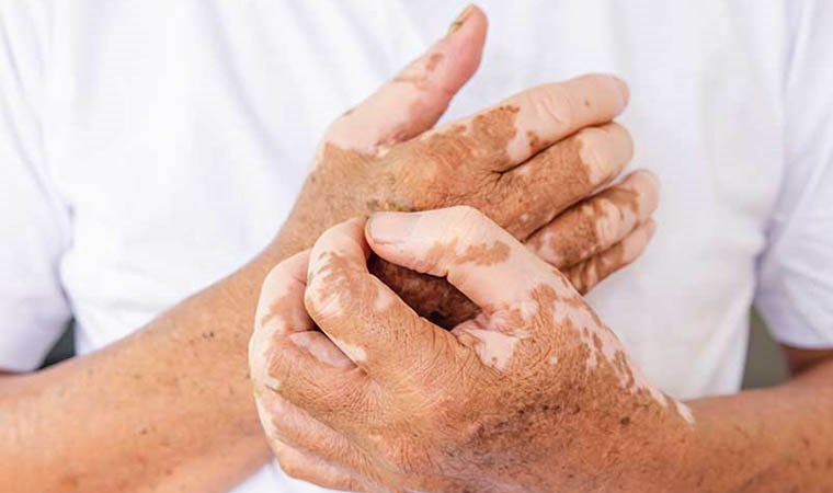 Stres ve travmalar vitiligo hastalığını tetikliyor